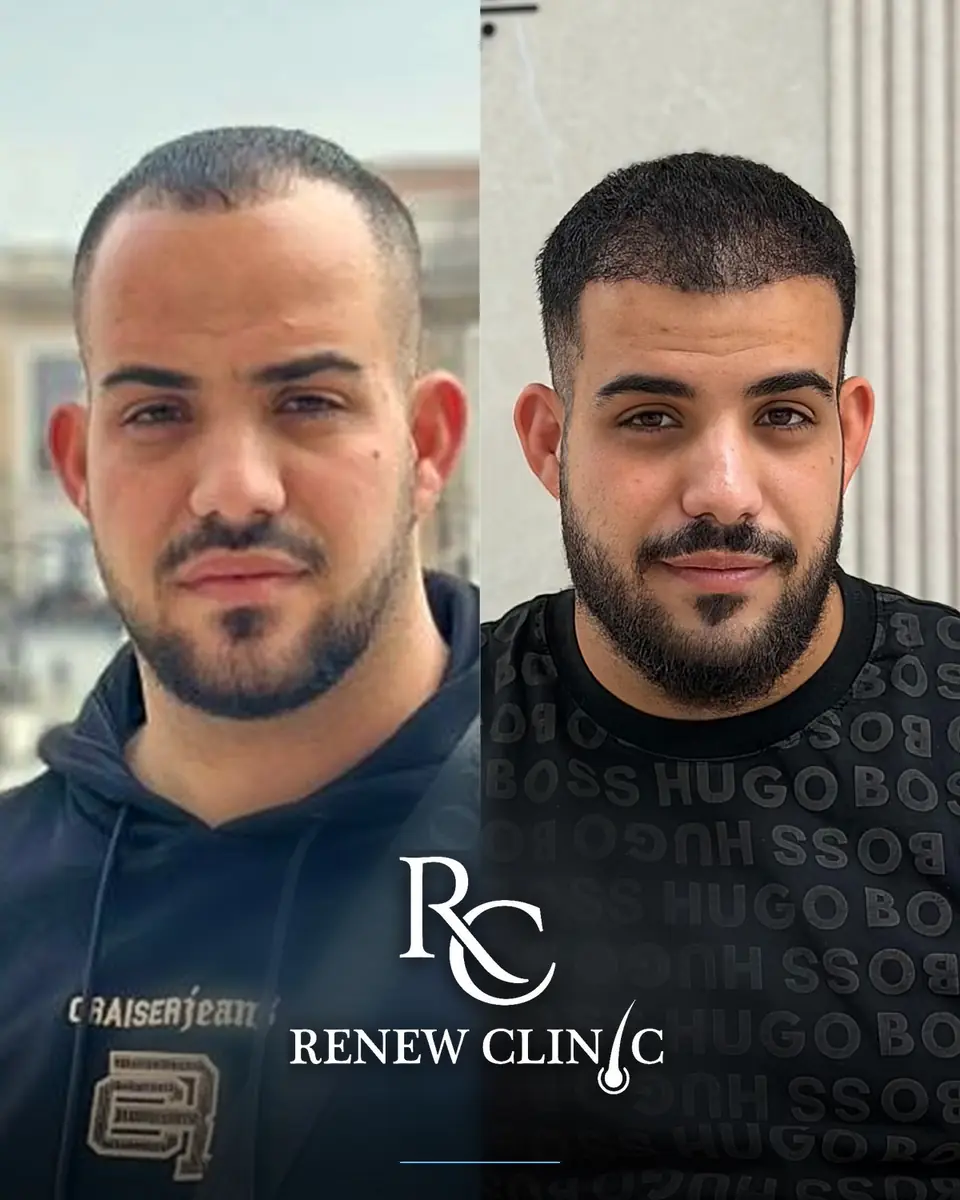 השתלת שיער לפני ואחרי — עיבוי שיער וקו שיער קדמי טבעי, ד״ר ערוה אבו ליל