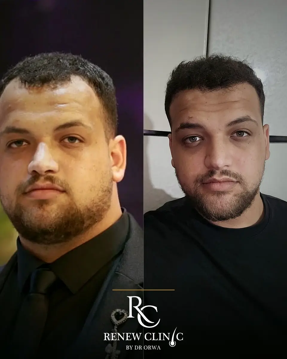 השתלת שיער לפני ואחרי — בנייה מחדש של קו השיער הקדמי, RENEW Clinic עין מאהל, ד״ר ערוה אבו ליל
