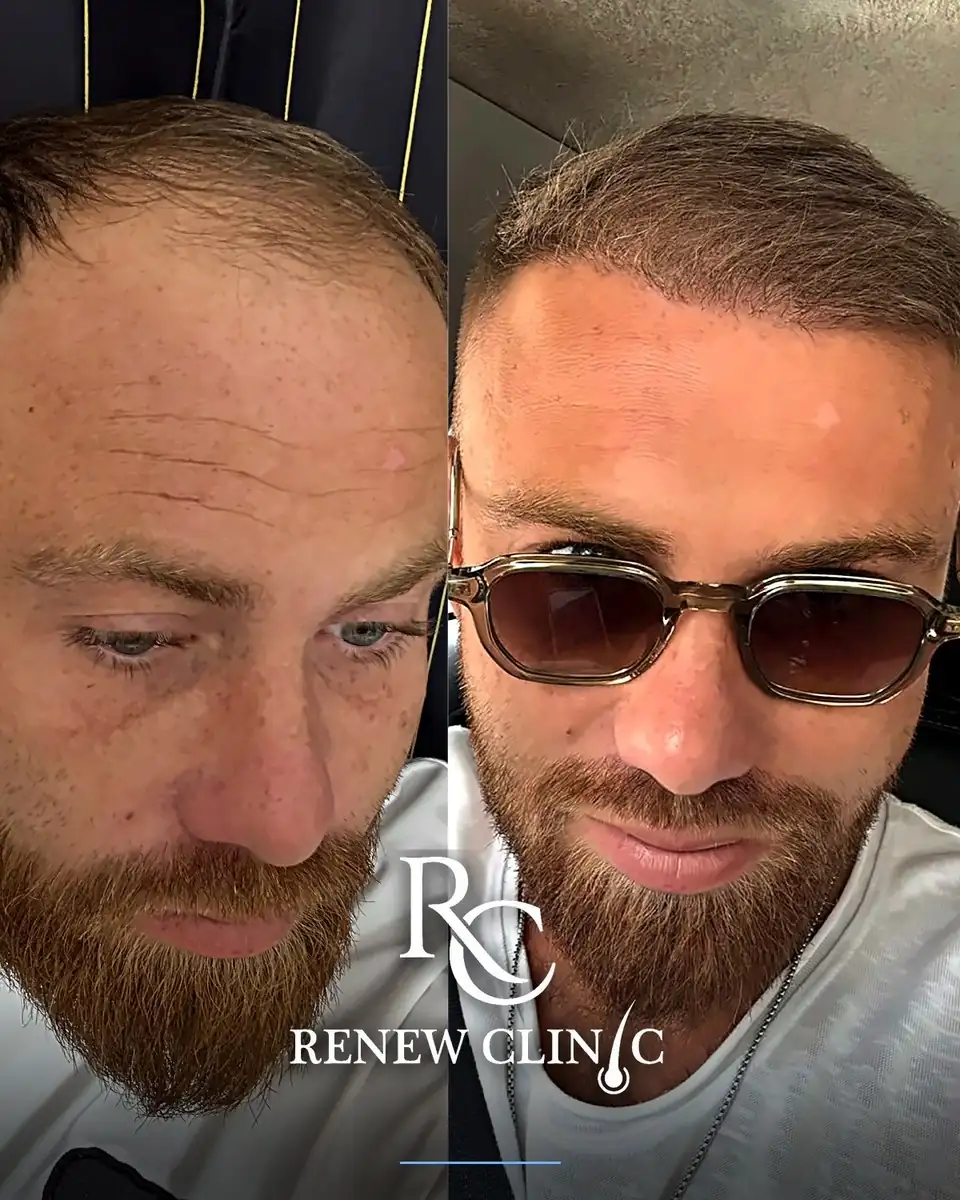 قبل وبعد — بعد خمسة أشهر ونصف من زراعة الشعر