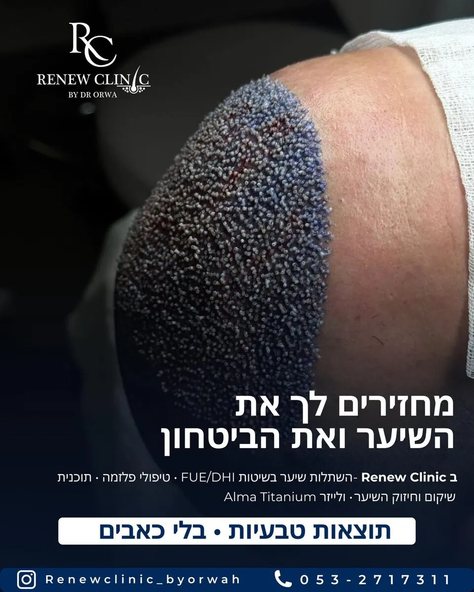 תוצאת השתלת שיער